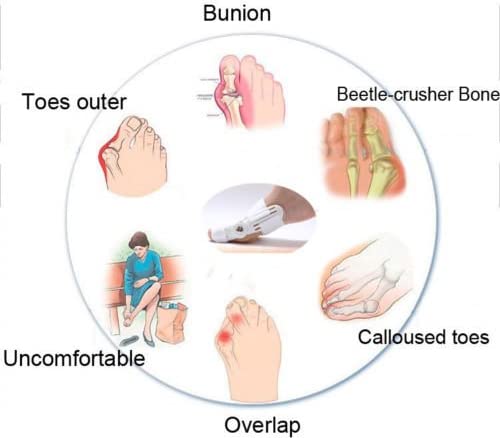 مصحح إبهام القدم العلاجي – بيج - Correcteur d'Hallux Valgus Thérapeutique – Beige